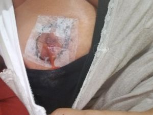 8 ngày sau Combo ngực bụng núm vú của tôi bị chảy máu và bụng bị sưng do di chuyển độ ngột, tôi nên làm gì?