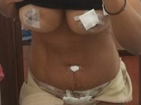 8 ngày sau Combo ngực bụng núm vú của tôi bị chảy máu và bụng bị sưng do di chuyển độ ngột, tôi nên làm gì?