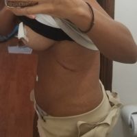 8 ngày sau Combo ngực bụng núm vú của tôi bị chảy máu và bụng bị sưng do di chuyển độ ngột, tôi nên làm gì?