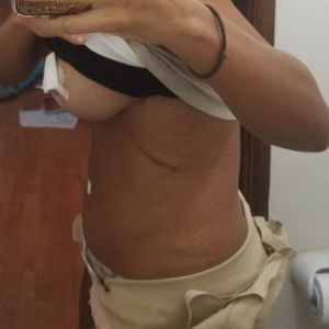 8 ngày sau Combo ngực bụng núm vú của tôi bị chảy máu và bụng bị sưng do di chuyển độ ngột, tôi nên làm gì?