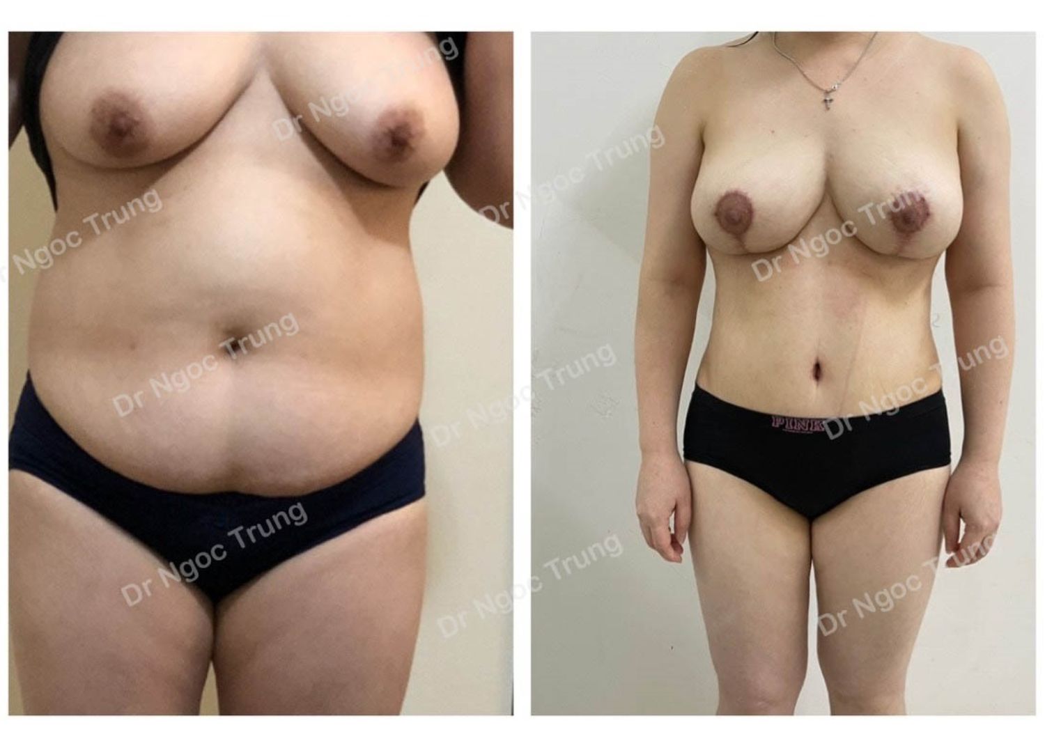 combo nguc bung dr ngoc trung ca 11