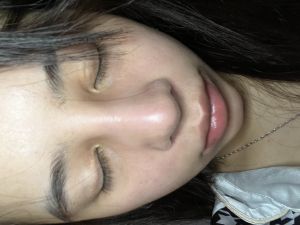 Mũi 8 tháng bị sưng do bầu hay do dị ứng chất liệu hay nhiễm trùng ạ ?