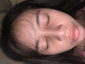 Mũi 8 tháng bị sưng do bầu hay do dị ứng chất liệu hay nhiễm trùng ạ ?