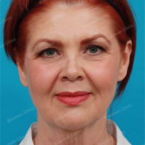 Căng da mặt, nữ 61 tuổi người Mỹ - case 1