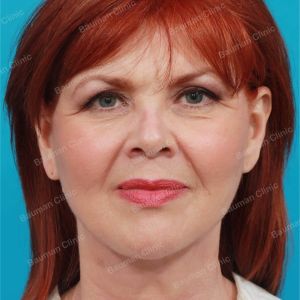 Căng da mặt, nữ 61 tuổi người Mỹ - case 1