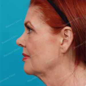 Căng da mặt, nữ 61 tuổi người Mỹ - case 1