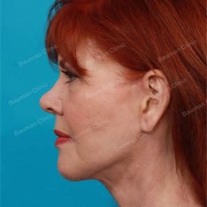 Căng da mặt, nữ 61 tuổi người Mỹ - case 1