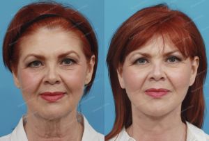 Căng da mặt, nữ 61 tuổi người Mỹ - case 1