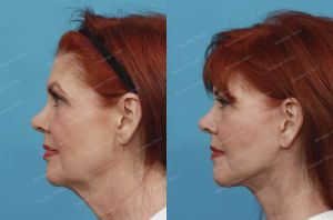 Căng da mặt, nữ 61 tuổi người Mỹ - case 1