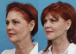 Căng da mặt, nữ 61 tuổi người Mỹ - case 1