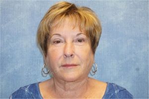 Căng da mặt nữ 63 tuổi, khách hàng Mỹ - case 10