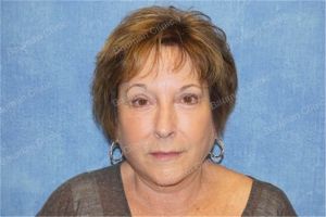 Căng da mặt nữ 63 tuổi, khách hàng Mỹ - case 10