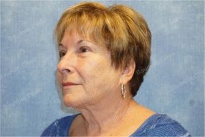 Căng da mặt nữ 63 tuổi, khách hàng Mỹ - case 10