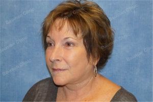 Căng da mặt nữ 63 tuổi, khách hàng Mỹ - case 10