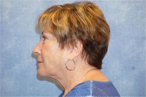 Căng da mặt nữ 63 tuổi, khách hàng Mỹ - case 10