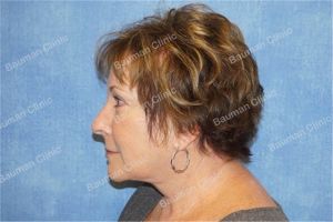 Căng da mặt nữ 63 tuổi, khách hàng Mỹ - case 10