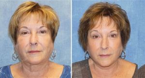 Căng da mặt nữ 63 tuổi, khách hàng Mỹ - case 10