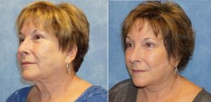 Căng da mặt nữ 63 tuổi, khách hàng Mỹ - case 10