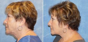 Căng da mặt nữ 63 tuổi, khách hàng Mỹ - case 10