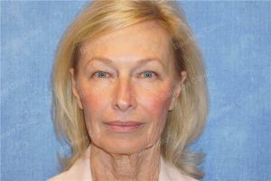 Căng da mặt nữ 69 tuổi, khách hàng Mỹ - case 11