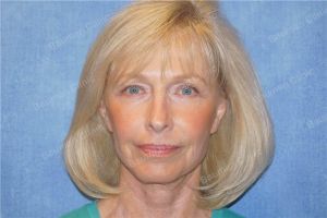 Căng da mặt nữ 69 tuổi, khách hàng Mỹ - case 11