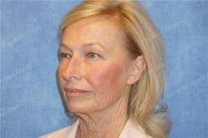 Căng da mặt nữ 69 tuổi, khách hàng Mỹ - case 11