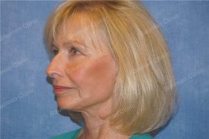 Căng da mặt nữ 69 tuổi, khách hàng Mỹ - case 11