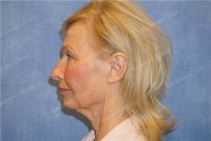 Căng da mặt nữ 69 tuổi, khách hàng Mỹ - case 11