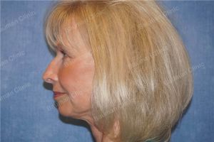 Căng da mặt nữ 69 tuổi, khách hàng Mỹ - case 11