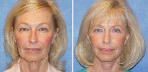 Căng da mặt nữ 69 tuổi, khách hàng Mỹ - case 11