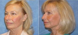 Căng da mặt nữ 69 tuổi, khách hàng Mỹ - case 11