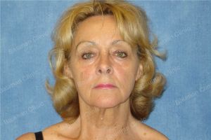 Căng da mặt nữ 67 tuổi người Mỹ - case 12