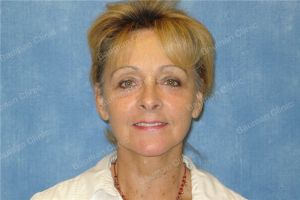 Căng da mặt nữ 67 tuổi người Mỹ - case 12