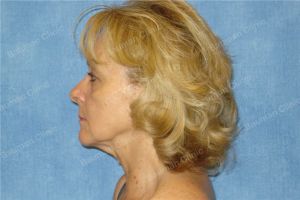 Căng da mặt nữ 67 tuổi người Mỹ - case 12