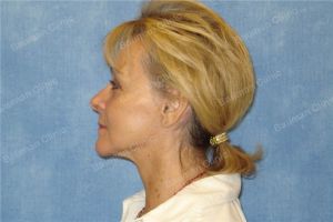 Căng da mặt nữ 67 tuổi người Mỹ - case 12