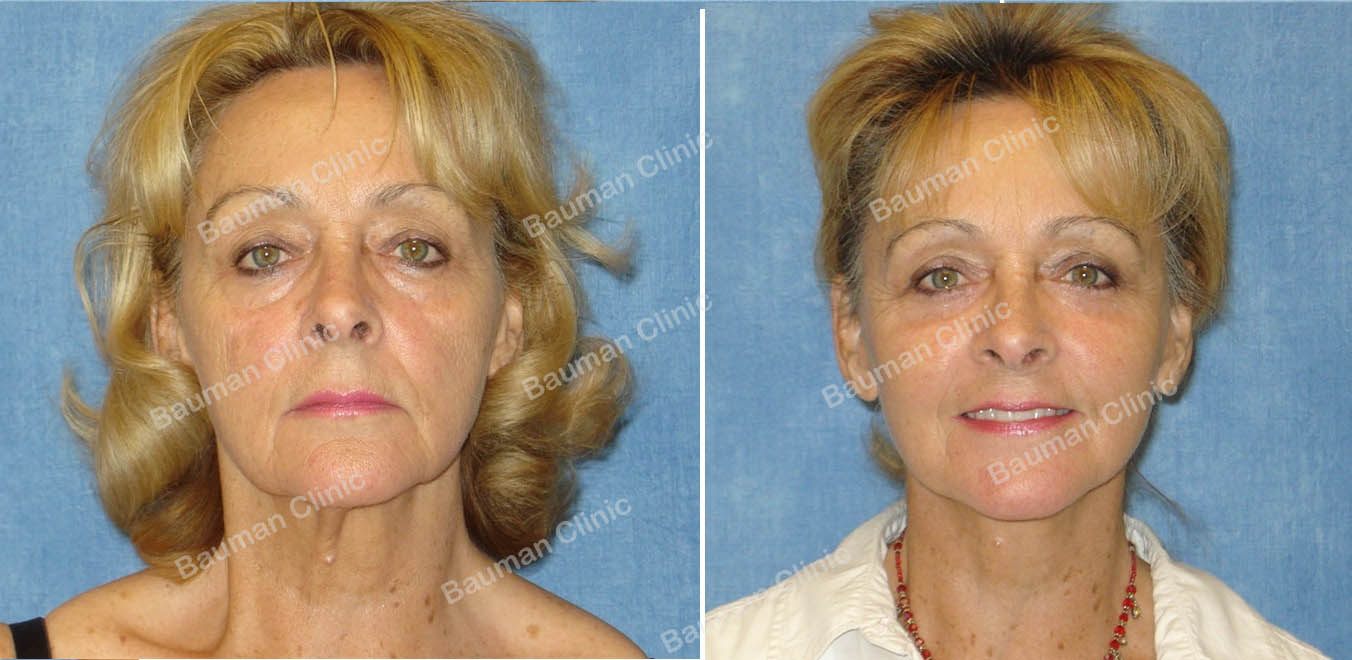 Căng da mặt nữ 67 tuổi người Mỹ - case 12