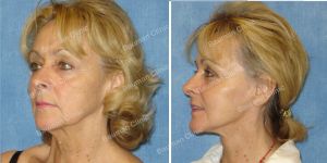 Căng da mặt nữ 67 tuổi người Mỹ - case 12