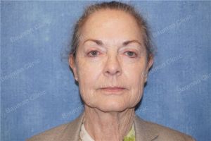 Căng da mặt nữ 71 tuổi người Mỹ - case 13