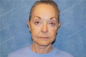 Căng da mặt nữ 71 tuổi người Mỹ - case 13