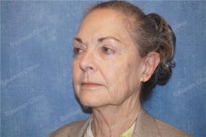 Căng da mặt nữ 71 tuổi người Mỹ - case 13