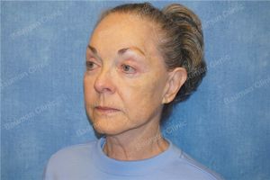 Căng da mặt nữ 71 tuổi người Mỹ - case 13