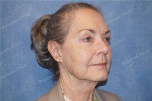 Căng da mặt nữ 71 tuổi người Mỹ - case 13