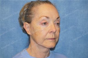 Căng da mặt nữ 71 tuổi người Mỹ - case 13
