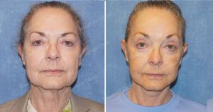 Căng da mặt nữ 71 tuổi người Mỹ - case 13