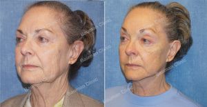 Căng da mặt nữ 71 tuổi người Mỹ - case 13