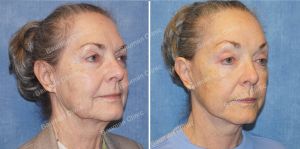 Căng da mặt nữ 71 tuổi người Mỹ - case 13