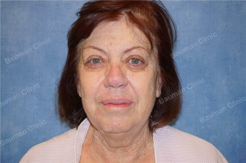 Căng da mặt nữ 68 tuổi người Mỹ - case 14