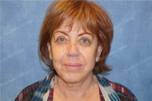 Căng da mặt nữ 68 tuổi người Mỹ - case 14