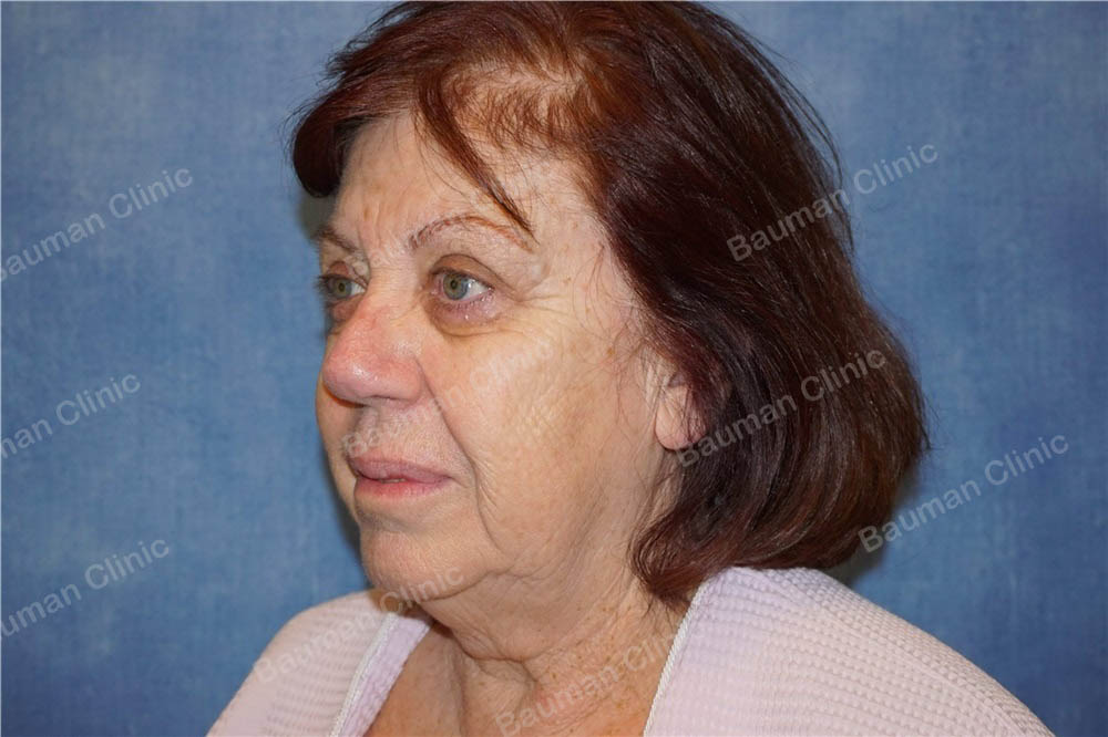 Căng da mặt nữ 68 tuổi người Mỹ - case 14