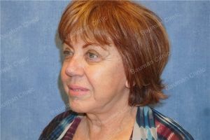 Căng da mặt nữ 68 tuổi người Mỹ - case 14